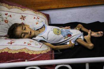 Gazze’de çocuklarda akut yetersiz beslenme rekor seviyeye ulaştı